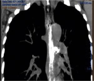 Tomografía de tórax con medio de contraste. Se observa neumomediastino y fuga del material de contraste por la cara lateral izquierda del esófago.