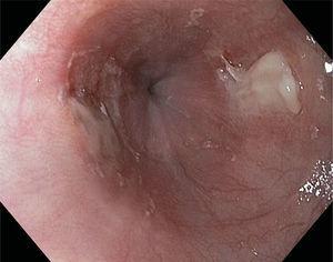Esofagoscopia de alta definición y luz blanca que muestra 2 úlceras en el tercio distal del esófago que se disponen una frente a otra, en espejo.