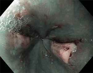 Úlceras en espejo en tercio distal del esófago vistas mediante imagen de banda estrecha (NBI), la cual resalta patrones vasculares y zonas de hemorragia.