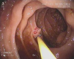 En endoscopia digestiva alta se visualizan numerosas lesiones sobreelevadas en bulbo y segunda porción duodenal, compatibles con neumatosis quística intestinal.