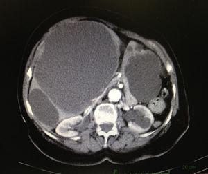 Tomografía computarizada abdominal que muestra quistes hepáticos voluminosos.