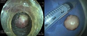 Visión endoscópica de la lesión a través del túnel y extracción en bloque de 25×28mm. Diagnóstico final: leiomioma.