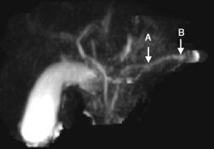 Imagen de colangiorresonancia con contraste. A) Zona de estenosis focal. B) Dilatación. Imagen en arrosariamiento del conducto de Wirsung.