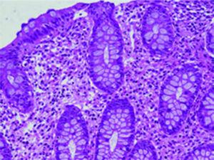 Infiltración de más de 15 eosinófilos por campo de alto poder en mucosa de recto en paciente con APLV.
