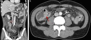 a y b) Imágenes de TC abdominal (corte transversal y coronal) que confirman lesión estenosante adyacente a válvula ileocecal (señalado por la flecha roja).