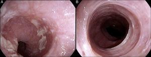 Hallazgos endoscópicos de esofagitis eosinofílica. A) Varias placas blancas o exudados se encontraron en el tercio medio y distal de la mucosa esofágica. B) Anillos esofágicos y esófago de calibre estrecho (esófago felino o traquelización esofágica).