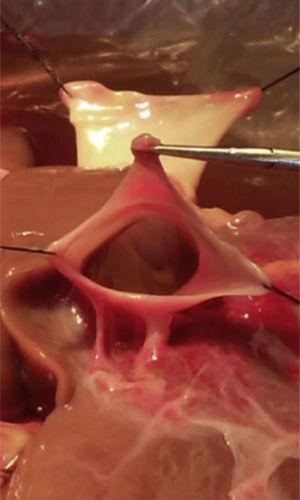 Vena cava inferior disecada.