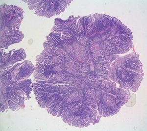 Imagen microscópica en la que se evidencia formación polipoide de eje ramificado fibroconectivo con bandas musculares lisas, y revestimento por mucosa intestinal de superficie vellosa compatible con pólipo hamartomatoso.