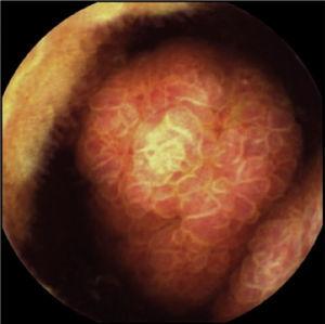 Imagen de la cápsula endoscópica en la que se objetiva gran pólipo ulcerado que ocupa parte de la luz intestinal.
