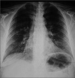 Radiografía de tórax inicial dentro de los parámetros normales.