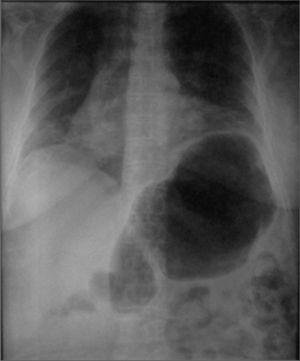Radiografía de tórax de seguimiento, donde se observa elevación del hemidiafragma izquierdo, por dilatación importante de la cámara gástrica, no evidente en la radiografía previa.