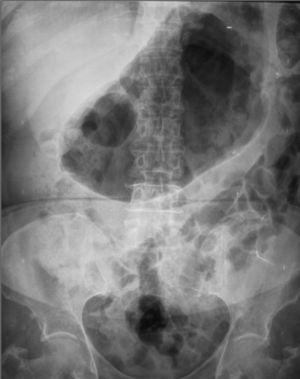 Radiografía complementaria del abdomen en donde se aprecia importante dilatación de la cámara gástrica, sin embargo el calibre de las asas intestinales y el grosor de las paredes es normal.