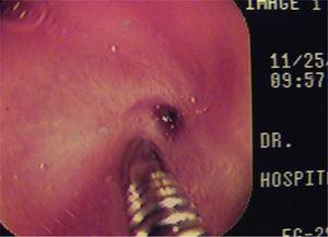 Estenosis esofágica puntiforme y paso de guía metálica flexible a través de la misma hasta estómago.