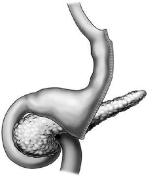 Aspecto anatómico de la gastrectomía vertical (Sleeve).