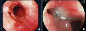 Fístulas gastrocutáneas poscirugías bariátricas. a) En la porción alta de la línea de sutura de la bolsa, posderivación gástrica. b) Posgastrectomía vertical.