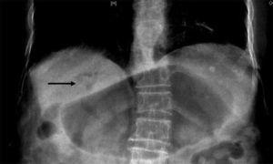 Placa de tórax donde se observa dilatación gástrica y neumobilia (flecha negra).
