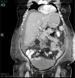 TAC de abdomen con contraste iv, que documenta necrosis de grasa peripancreática y espacio pararrenal anterior izquierdo; el mesocolon muestra la presencia de gas.