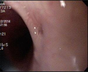 Imagen endoscópica de fístula traqueoesofágica posterior al tratamiento.