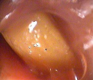 El examen de fibra óptica revela un cuerpo extraño con forma de hueso (*) en el esófago proximal.