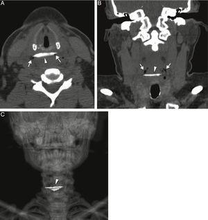 A) Imágenes axial y B) coronal de la tomografía computarizada que muestran el cuerpo extraño con forma de hueso (punta de flecha) a la altura del esófago proximal, con pequeñas burbujas de aire en el tejido blando (flechas), como indicación de una perforación limitada. C) La reconstrucción de imagen del renderizado de volumen 3D de la tomografía computarizada coronal del cuerpo extraño con forma de hueso (punta de flecha).