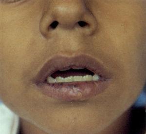 Máculas hipercrómicas en los labios.