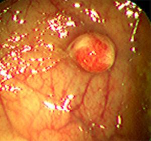 Imagen endoscópica de pólipo colónico hamartomatoso en el paciente.