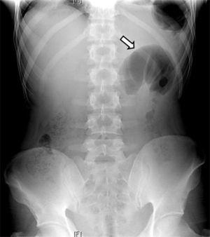 Placa simple de abdomen en posición de pie con asa fija en hemiabdomen izquierdo (flecha blanca) e imagen en vidrio despulido.