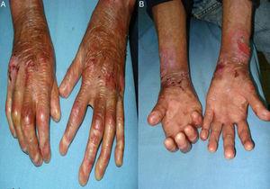 A) Pérdida de uñas, erosiones y costras hemáticas en el dorso de manos. B) Úlceras, erosiones y costras hemáticas en muñecas y antebrazos.
