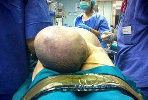 La exploración clínica que muestra la presencia de la hernia inguinal derecha gigante.