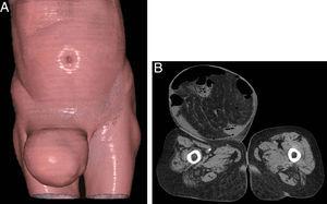 A) Imagen de una tomografía coronal computarizada con técnica de renderización de volumen que muestra la presencia de la hernia inguinal derecha grande. B) Imagen de una tomografía axial computarizada que muestra una hernia directa pasando a través del conducto inguinal con protuberancia de segmentos intestinales.