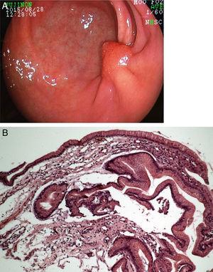 A) Endoscopía de seguimiento 6 meses después de la DESM, mostrando convergencia de pliegues y un nódulo polipoide aberrante en la cicatriz. B) La histología reveló tejido hiperplásico regenerativo.