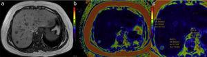 Adenoma hepático con grasa. a) La secuencia T1 muestra 3pequeñas lesiones focales en los segmentos 7 y 8 del hígado. El mapa de color para cuantificar grasa muestra que 2de ellas tienen tonos azulados en el centro (b) donde la concentración de lípidos fue de 37 y 19%, respectivamente (c). El diagnóstico histológico fue de adenoma HNF1.