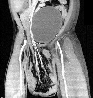 La angiotomografía de abdomen en plano coronal muestra asas intestinales de intestino delgado en saco herniario extraabdominal, sin compromiso vascular, y vejiga llena.