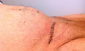 Cicatriz de incisión inguinal derecha de 8cm de longitud en paciente con hernia inguino-escrotal previa.