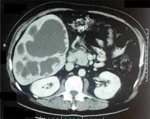 Tomografía computarizada con doble contraste mostrando en corte axial: hígado aumentado de volumen, con múltiples lesiones quísticas de 18 unidades Hounsfield (líquido espeso), correspondiendo a abscesos hepáticos amebianos.