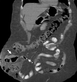 Tomografía abdominal. Corte coronal donde se observa el ciego (flecha blanca), apendicitis aguda (flecha blanca punteada) y absceso de pared (flecha negra) dentro del saco herniario.
