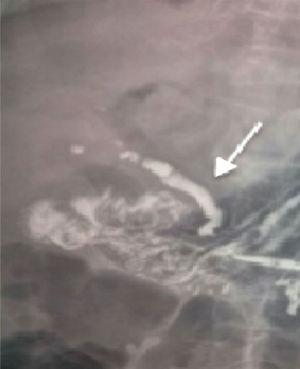 Radiografía abdominal reforzada con medio de contraste mostrando el signo de Petren (flecha).