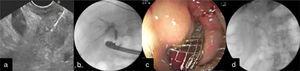 a) Vista por el USE de tumor pancreático y BAAF; b) Imagen por fluoroscopia de acceso a la vía biliar mediante punción guiada por el USE; c) Colocación de prótesis intestinal en la 2.ª porción duodenal, y d) Prótesis (biliar e intestinal) colocadas.