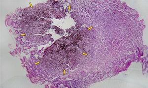 Mucosa gástrica oxíntica. Infiltración parcial con pérdida de arquitectura de foveolas y glándulas por células neoplásicas con patrón difuso, discohesivo.