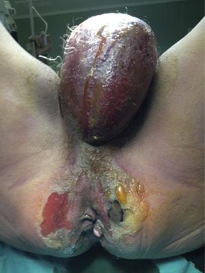 Imagen preoperatoria. Celulitis y placas de necrosis a nivel de ambas fosas isquiorrectales que se extiende a periné y testículos.