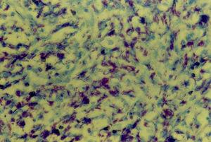 Fotomicrografía, gran aumento con tinción de Ziehl-Neelsen, con bacilos tuberculosos.