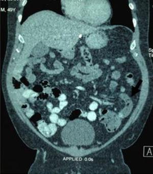 Corte coronal de tomografía abdominal. Apendicitis aguda en el hemiabdomen izquierdo (flecha negra), sin evidencia de otros síndromes asociados.