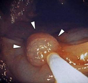 Endoscopia del colon ascendente mostrando un pólipo adenomatoso (cabezas de flecha).