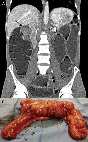 A) TC de abdomen que detecta masa a nivel de ángulo hepático, sugerente de causa obstructiva. B) Examen macroscópico de pieza quirúrgica (colon derecho), con múltiples implantes (flechas) sugerentes de carcinomatosis difusa.