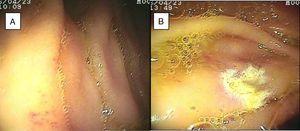 Mucosa de yeyuno con angiodisplasia antes (A) y después (B) de aplicación de argón plasma.