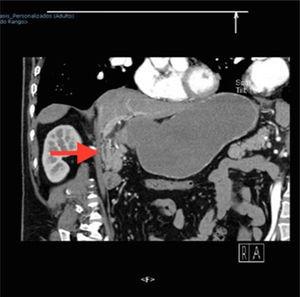 TAC de abdomen en fase contrastada en la cual se observa engrosamiento antro-pilórico y del bulbo duodenal.