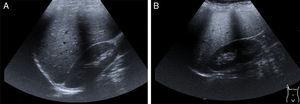 A) Imagen de hígado normal obtenida por ultrasonido. B) Se observa hígado con esteatosis. Es posible identificar hepatomegalia.