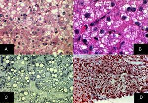 A) Esteatosis microvesicular difusa, se aprecian múltiples vacuolas claras dentro del citoplasma de los hepatocitos (H&E, aumento original x 400). B) Las vacuolas miden alrededor de una micra de diámetro y no desplazan al núcleo (H&E, aumento original x 400). C) Cortes semifinos que muestran la naturaleza microvesicular de la esteatosis, la cual se aprecia en prácticamente todos los hepatocitos (azul de toluidina, aumento original x 400). D) Múltiples gotas de grasas neutras se revelan en todo el lobulillo hepático (rojo oleoso, aumento original x 200).