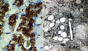 A) En esta reacción de inmunohistoquímica se observa que las gotas de lípidos se encuentran en lisosomas (catepsina D, aumento original x 400). B) En esta fotomicrografía se aprecia que los lípidos están rodeados de una unidad simple de membrana que revela su naturaleza lisosomal; se aprecian también cristales de colesterol (microscopía electrónica, aumento original x 2,000).