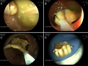 A) Prótesis dental impactada en divertículo. B) Extracción de prótesis con asa. C) Paso de prótesis a través de anastomosis. D) Prótesis dental extraída.